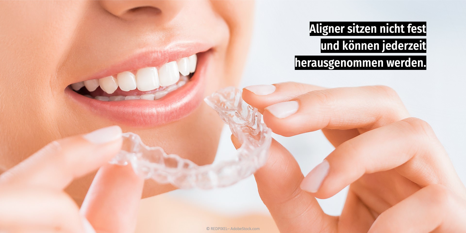 Zahnregulierung mit Alignern