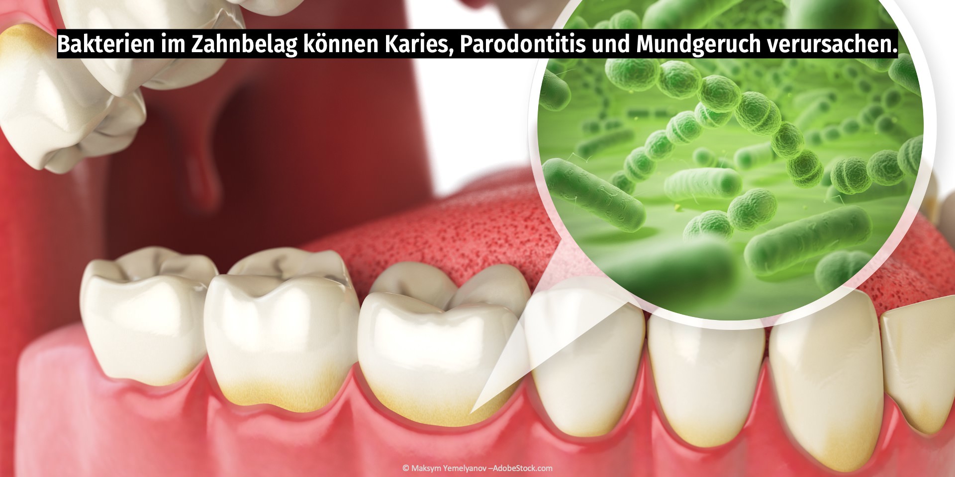 Bakterien im Zahnbelag