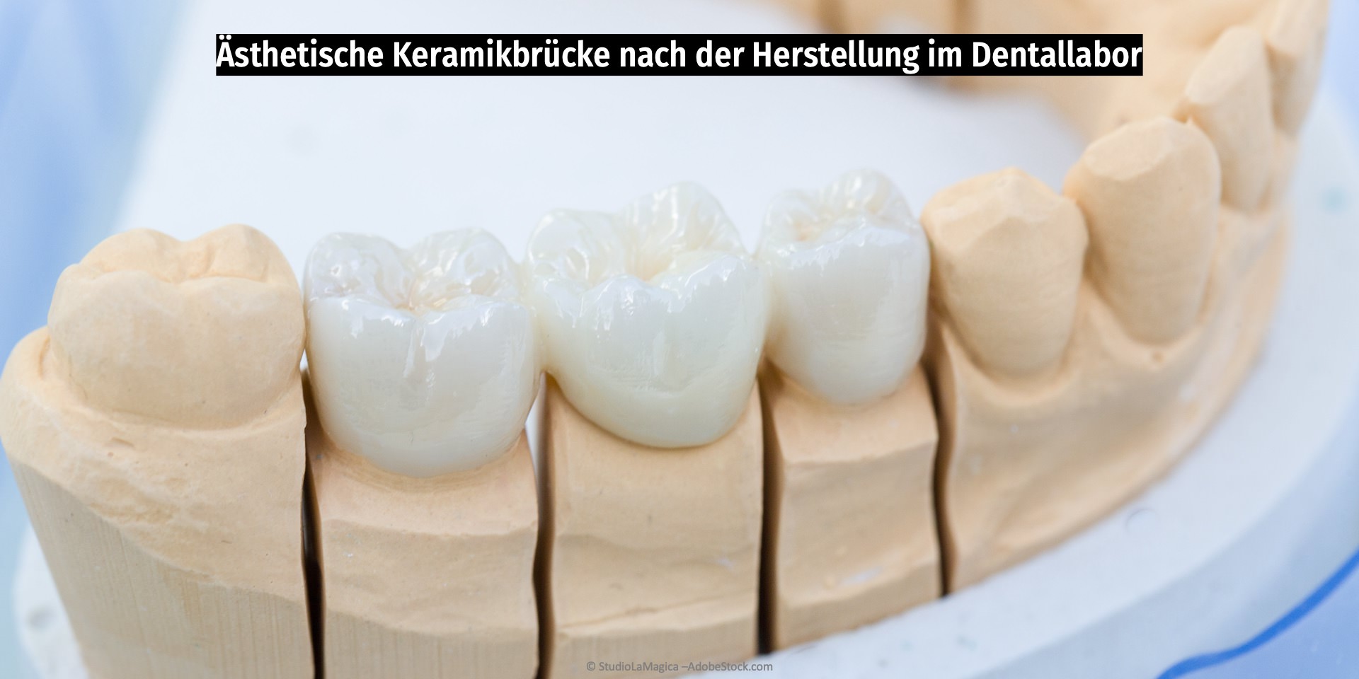 Zahnbrücke aus reiner Keramik